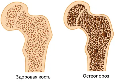 Остеопороз суставов: лечение, симптомы, виды