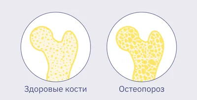 Остеопороз • Центр ортопедии и подологии Ортоэксперт