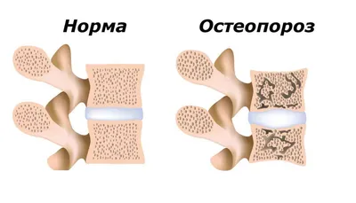 Остеопороз глазами разных специалистов. - Painmed