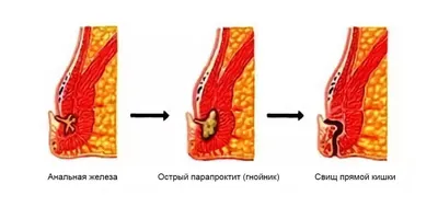 Хронический парапроктит. Свищ | Пикабу