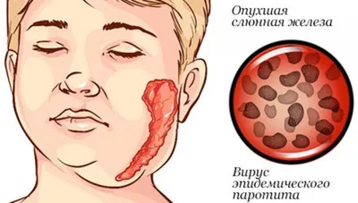 Зачем нужна прививка от паротита и чем опасна свинка