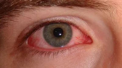 Knowing What Pink Eye Looks Like