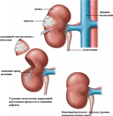 Лапароскопическая резекция почки / Урологическое отделение