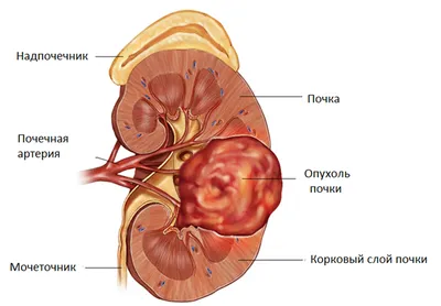 Рак почки| Блог UNIM