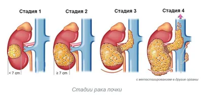 9 марта—Всемирный день почки. Нужно ли «чистить» почки и сколько пить  жидкости, чтобы поддержать их здоровье, рассказал заведующий отделением  урологии БСМП №1 Роман Казаков. | Официальный сайт БУЗОО \"ГКБСМП №1\"