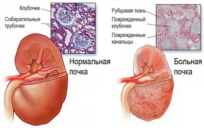 Симптомы рака почки – методы лечения