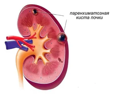 Органосохраняющие операции при опухоли (раке) почки