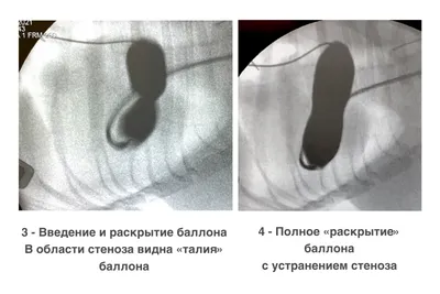 Баллонная вальвулопластика при стенозе легочной артерии у собаки | Статьи |  Ветеринарная клиника БЭСТ в Новосибирске