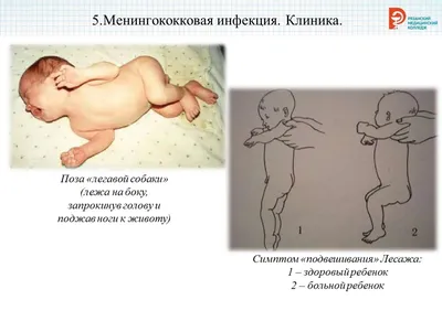 Менингококковвя инфекция - online presentation