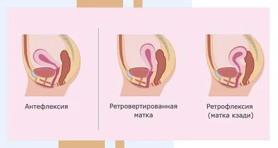 Как забеременеть при загибе шейки матки – клиника АльтраВита