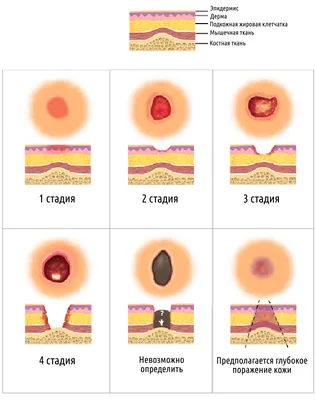 Пролежни | Пикабу