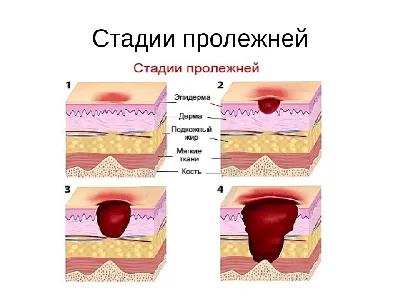 Пролежни: осложнения, особенности лечения и профилактика