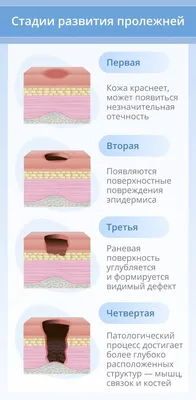 Пролежни у лежачих больных: чем опасны и как вылечить | Обнимая небо | Дзен