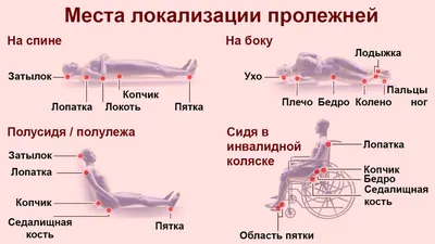 Профилактика и лечение пролежней у пожилых людей