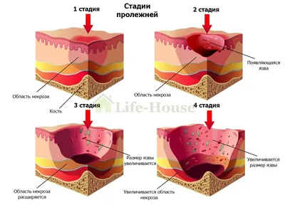 Как лечить пролежни у лежачих больных | Блог дома престарелых Life-House