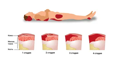 Пролежни фото картинки фотографии