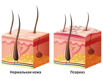 Псориаз: причины, симптомы, признаки, виды, как выглядит, как вылечить,  заразен ли