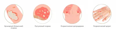 Псориаз: симптомы, лечение | Асмедия | Санкт-Петербург (СПб)