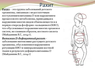 Рахит. Описание, признаки