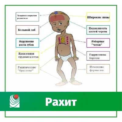 Рахит…. как поступать? - Центр по лечению асептического некроза