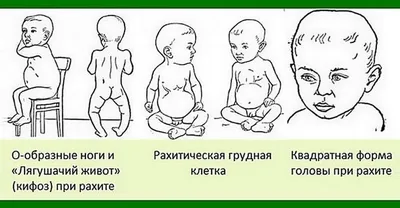 Рахит или нет ? — 9 ответов | форум Babyblog