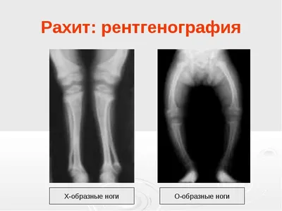 Рахит и рахитоподобные заболевания: клинико-рентгенологические,  биохимические проявления, лечение. Литературный обзор. – тема научной  статьи по клинической медицине читайте бесплатно текст  научно-исследовательской работы в электронной библиотеке ...