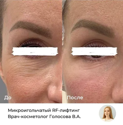 RF-лифтинг лица и тела | LM-CLINIC Бутово