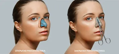 АМД Лаборатории Новосибирск - КОНТУРНАЯ ПЛАСТИКА НОСА 👃💉 🔝🔝🔝 Контурная  ринопластика – это безоперационная процедура коррекции носа, производимая  при помощи плотных натуральных гелей. Популярность приобрела относительно  недавно, но получила широкое ...