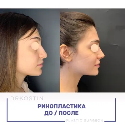 Ринопластика в Олимп здоровья