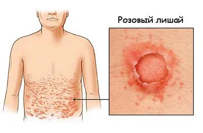 Лишай у человека | симптомы, причины и лечение