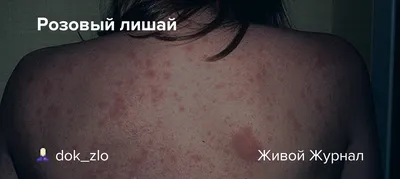 kiddydoc2019 - Розовый лишай (лишай Жибера, pityriasis... | Facebook