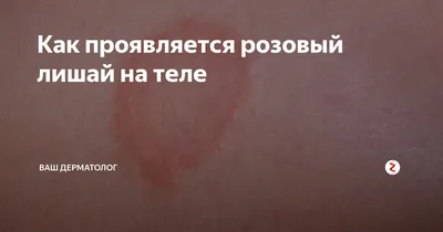 Розовый лишай - признаки, причины, симптомы, лечение и профилактика -  iDoctor.kz