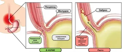 Рвота — это не наказание от желудка - Телеканал Доктор