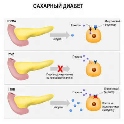 Как распознать сахарный диабет у детей? — интернет-магазин МедМаг СПб