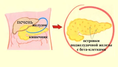 Сахарный диабет 2 типа