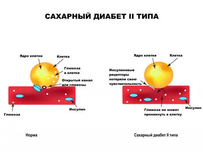 Как распознать сахарный диабет любого типа | Некоузская ЦРБ