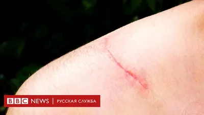 Шрамы остались на лице 8-летней девочки после укуса собаки в Читинском  районе - 30 июля 2023 - chita.ru