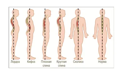 Как лечить сколиоз дома? Советы реабилитолога, физического терапевта