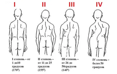 Сколиоз, виды искривления позвоночника у детей и взрослых, лечение сколиоза  в Москве