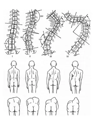 Искривление позвоночника лечение, сколиоз