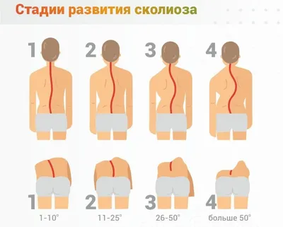 Сколиоз: фото, 1, 2, 3 и 4 степени, у детей, лечение, упражнения