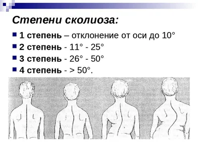 Лечение сколиоза в Киеве: цена на лечение сколиоза в ортопедии в клинике  Оксфорд Медикал