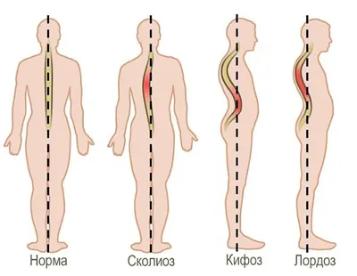 Найз - Программа здоровья - Как лечить сколиоз