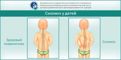 Как вылечить сколиоз 1 степени – признаки сколиоза у взрослых