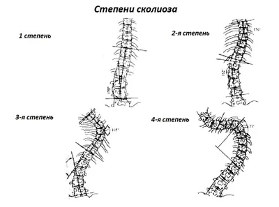 Правосторонний сколиоз - лечение, диагностика в Клинике Бакланова