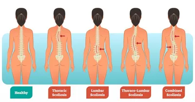 Юношеский идиопатический сколиоз и боль в спине - KinesioPro