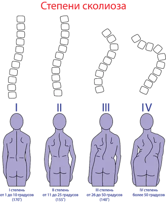 Сколиоз: фото, 1, 2, 3 и 4 степени, у детей, лечение, упражнения