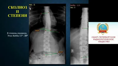 Сколиоз 1 степени | Болезнь бехтерева, Сколиоз, Лечение