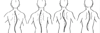 С каким сколиозом не берут в армию 2024? | Cколиоз 2 степени