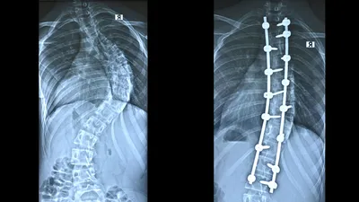 Сколиоз - фото пациентов